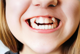 兒童早期干預(yù)矯正